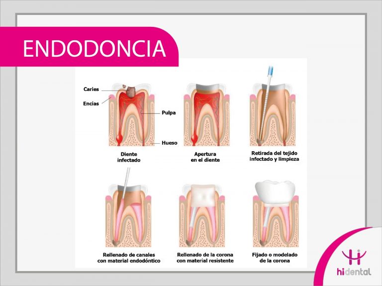 Endodoncia Hidental Cl Nica Odontol Gica Medell N Odontolog A Con